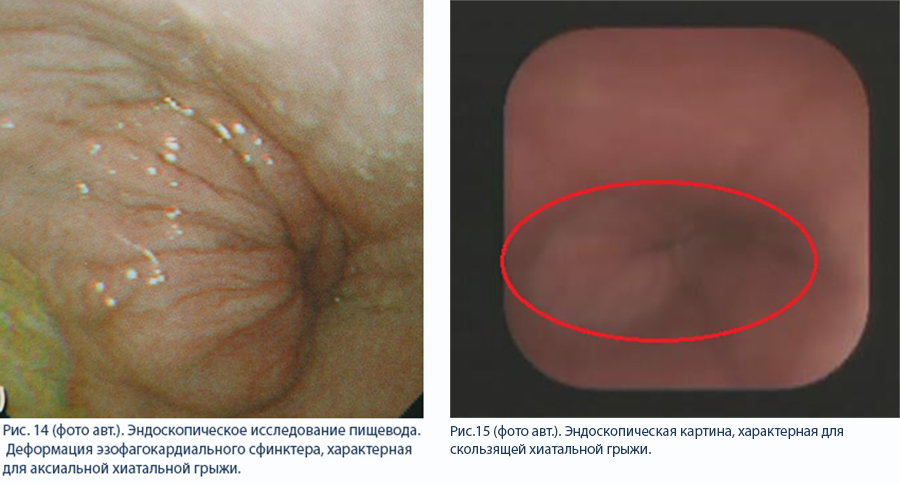 эндоскопическое иследование пищевода