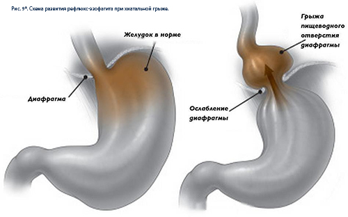 гастрит при хиатальной грыже
