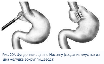 фундопликация по ниссену