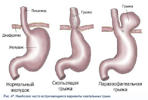 хиатальные грыжи