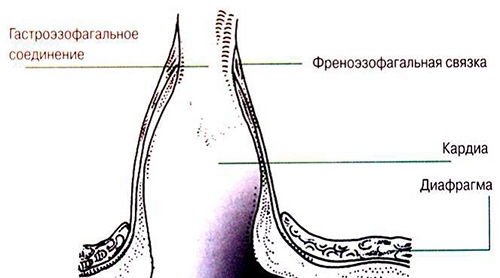 аксиальная хиатальная грыжа