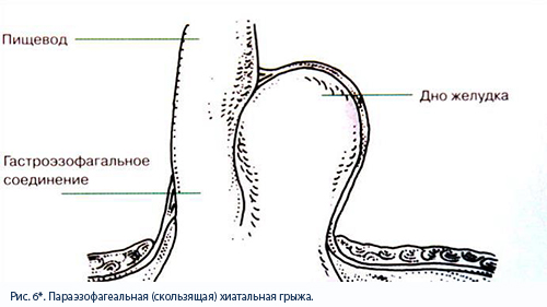 скользящая хиатальная грыжа