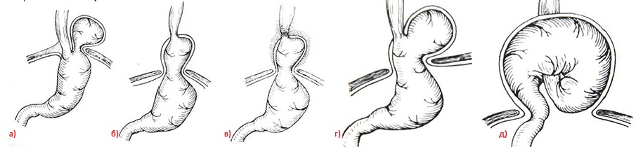 варианты хиатальных грыж