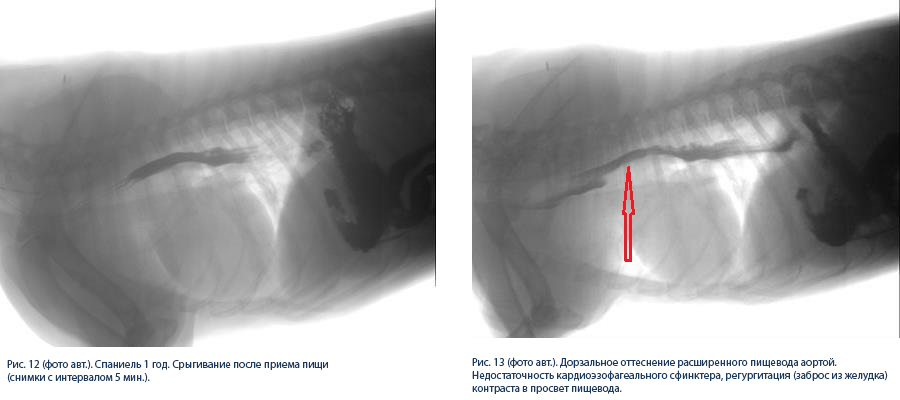 расширение пищевода