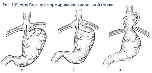 угол гиса